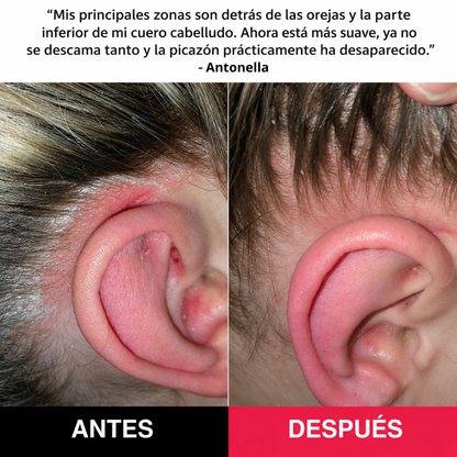 Alivio real para la caspa, la picazón y las impurezas del cuero cabelludo
