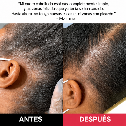 Alivio real para la caspa, la picazón y las impurezas del cuero cabelludo